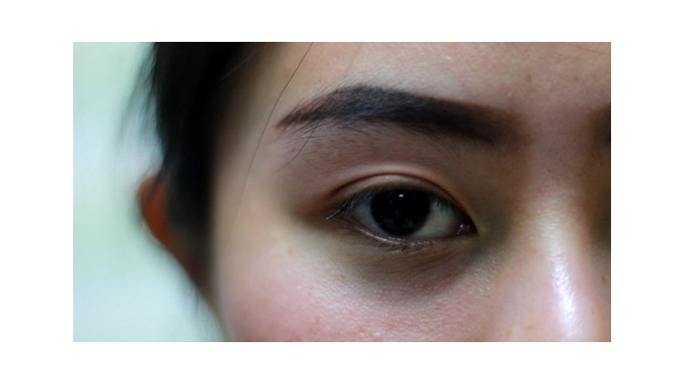 หนังตาหย่อน.. ปัญหาที่แก้ไขได้โดยจักษุแพทย์