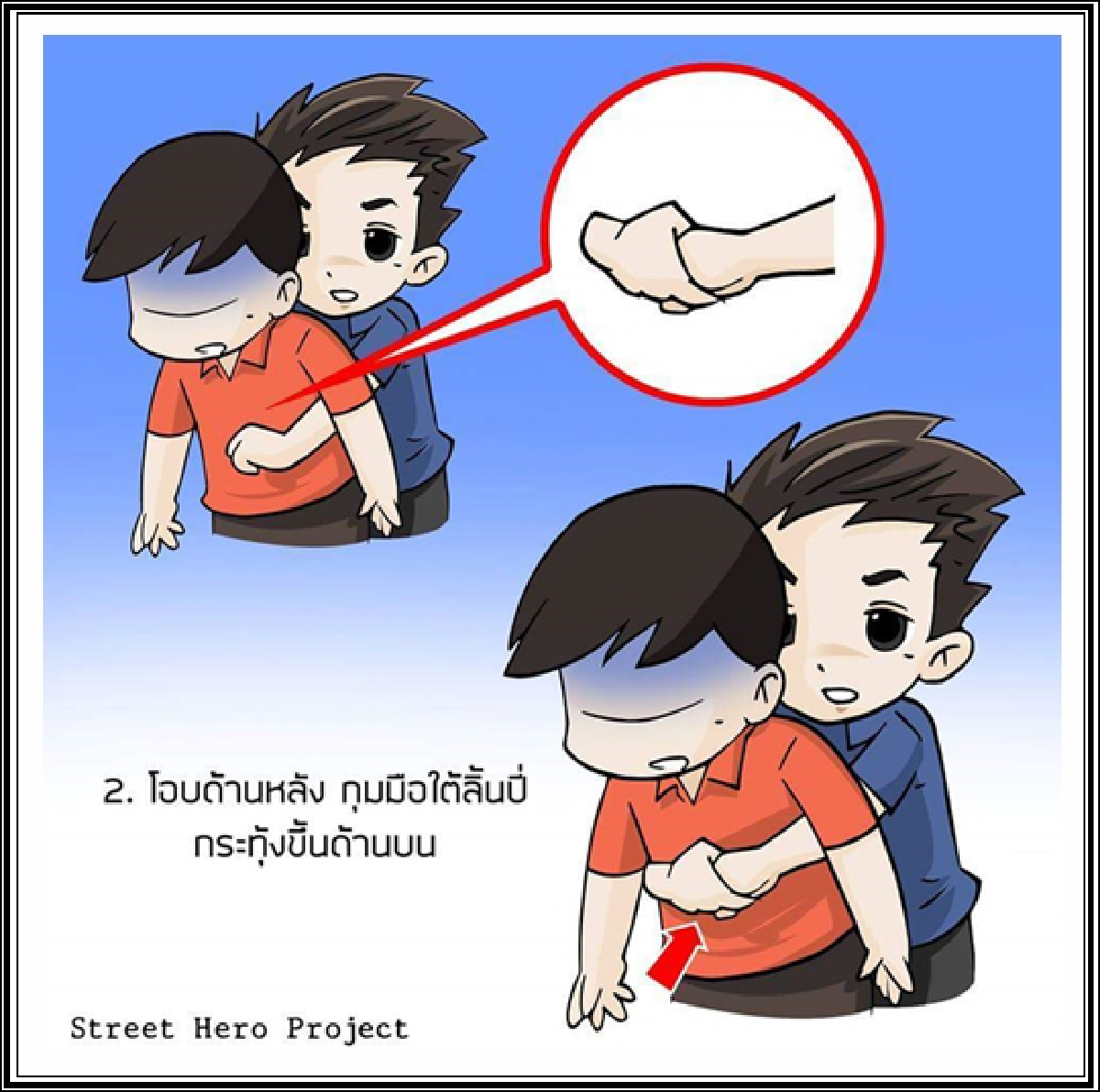สธ.แนะวิธีปฐมพยาบาลสิ่งแปลกปลอมอุดกั้นทางเดินหายใจ