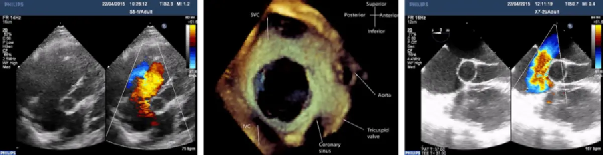 ‘ผนังกั้นหัวใจรั่ว’ รักษาได้ไม่ต้องผ่าตัด 