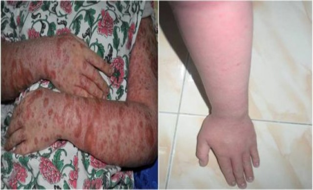 ความหวังใหม่ สู้สะเก็ดเงิน