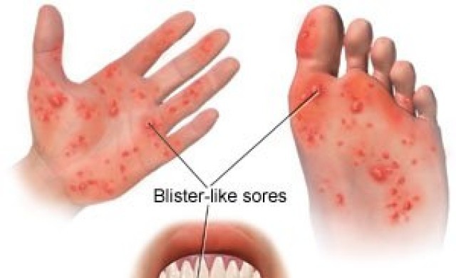 ระวัง มือ เท้า ปาก ในเด็ก