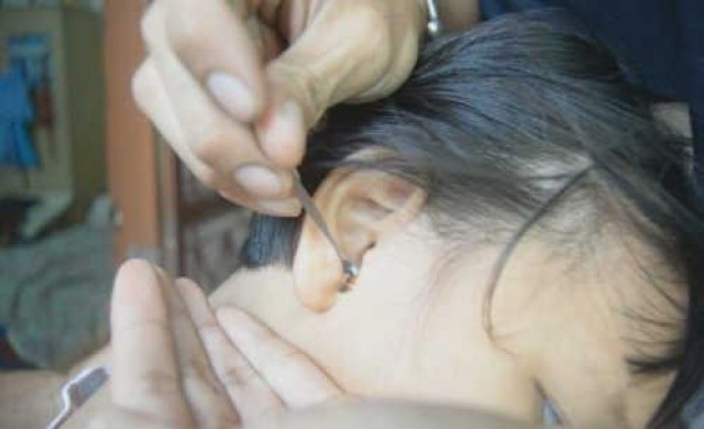 แพทย์นำเด็กตรวจหูหามดอย่างละเอียดไม่พบ