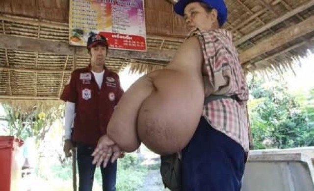 ทรมาน!ต่อมน้ำเหลืองเป็นพิษแขนบวมโต