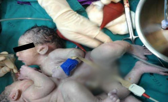 ผ่าคลอดแฝดสยามเพศหญิงตัวติดกัน