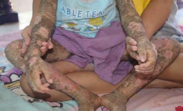 วอนช่วยเด็กชายป่วยโรคประหลาดแต่กำเนิด