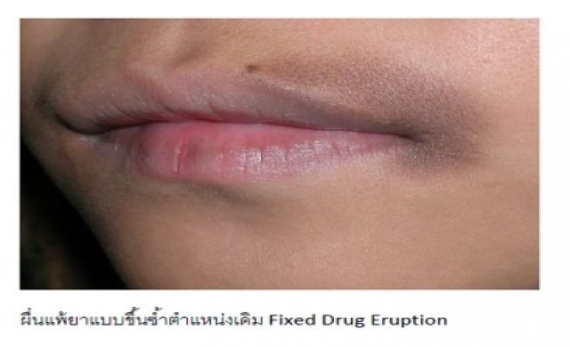 เรื่องน่ารู้ของอาการแพ้ยา