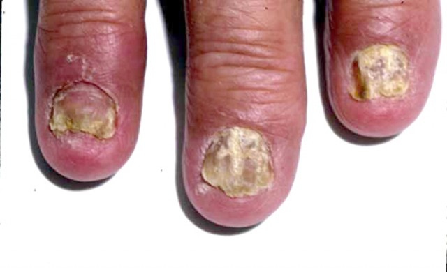 นักวิจัย มมส.เจ๋ง!พบสูตรชาสมุนไพรคุมและบรรเทาโรคสะเก็ดเงิน