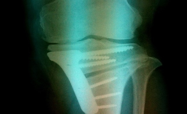 ทางเลือกของการผ่าตัดรักษาโรคข้อเข่าเสื่อม