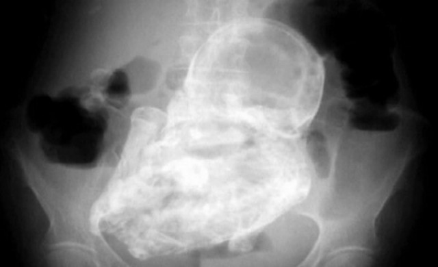 ยายชิลีวัย92ปีอุ้มท้อง'เด็กหิน'ในครรภ์มากว่า50ปี