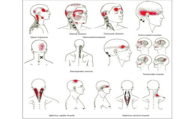 ยาไมเกรน ภัยร้ายใกล้ตัว