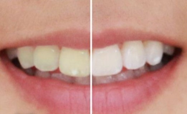 ทพ.เตือนซื้อ'เครื่องฟอกฟันขาว'สำเร็จรูปเสี่ยงอันตราย 