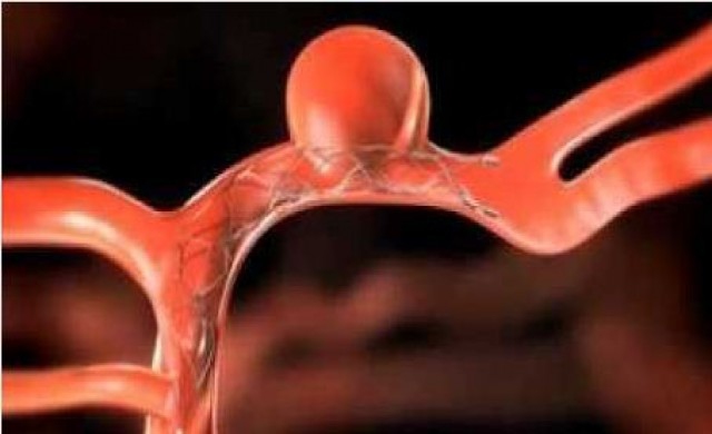 'วชิรพยาบาล'เปิดศูนย์ผ่าตัดหลอดเลือดสมองโป่งพอง 