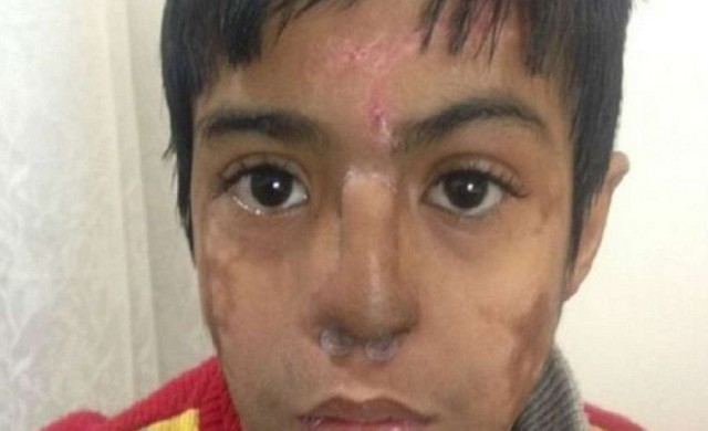 หมออินเดียปลูกถ่ายจมูกบนหน้าผาก