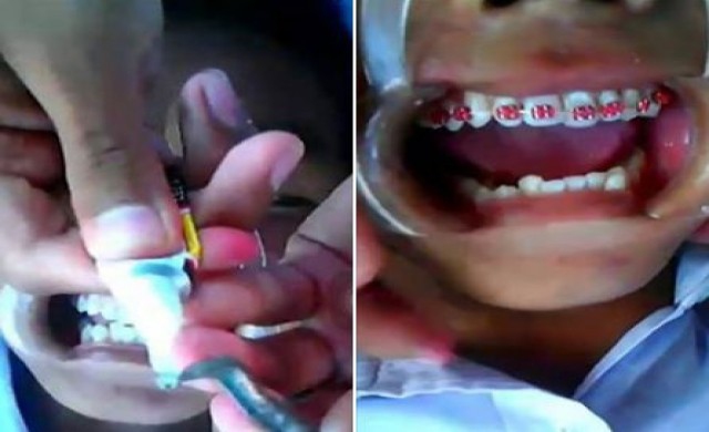 อึ้ง! เด็กใช้กาวตราช้างติดลวดจัดฟันแฟชั่น 