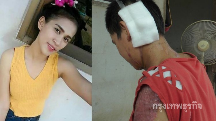 สาวเคราะห์ร้าย ถูกสามีเมาราดน้ำกรดตาใกล้บอดเลี้ยงลูก2คน