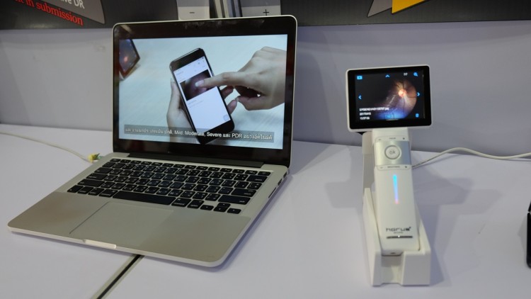 แอพฯส่องเบาหวานขึ้นตา รางวัลแกรนด์ไพรซ์เจนีวา