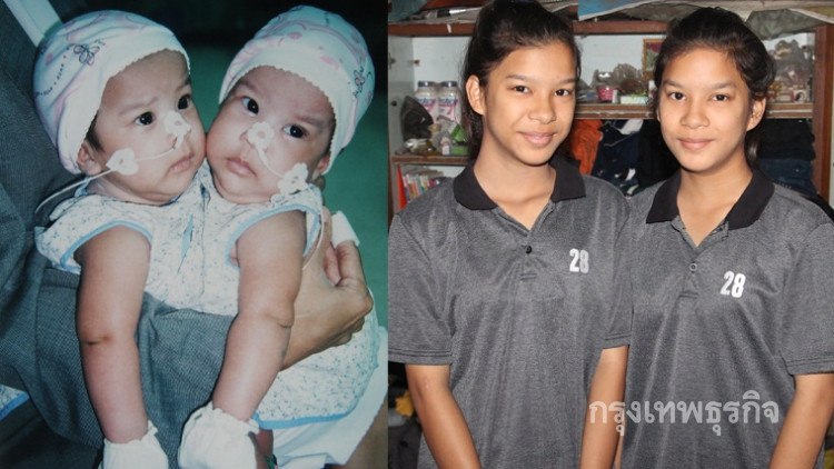 ย้อนอดีตแฝดสยามของไทยโตเป็นสาวแล้ว!!