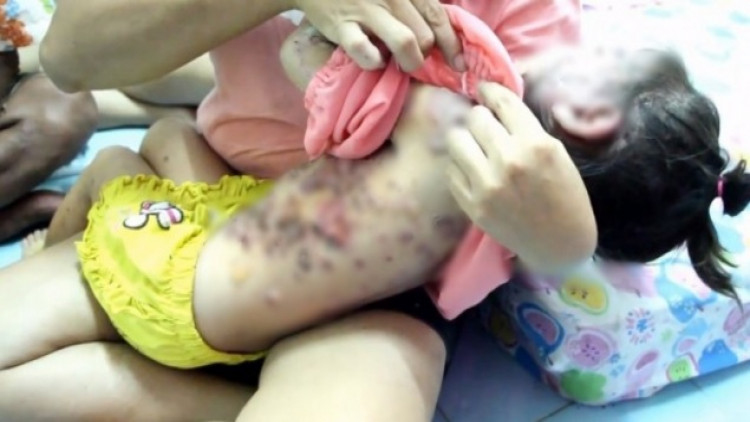 ในหลวงทรงรับ 'น้องน้ำขิง' เป็นคนไข้ในพระราชูปถัมภ์