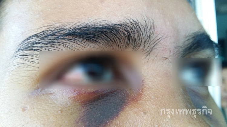 เยาวชนวัย 16 ปี เปิดใจนาทีการ์ดรุมซ้อมจมูกหัก-ตาเขียวช้ำ