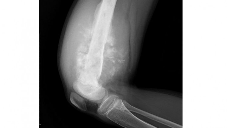 เตือนเนื้องอกกระดูก พบก้อนแข็งที่แขน ขา อย่านิ่งนอนใจควรปรึกษาแพทย์