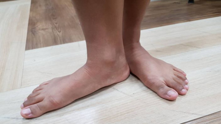 เท้าแบนไม่ใช่โรค รู้ก่อนป้องกันได้