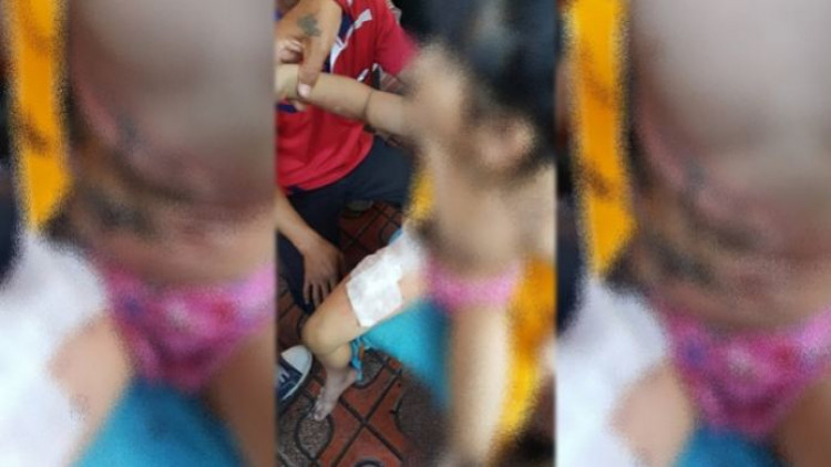 ลูกโป่งอัดแก๊สระเบิด หนูน้อยวัย 6 ขวบ เจ็บ