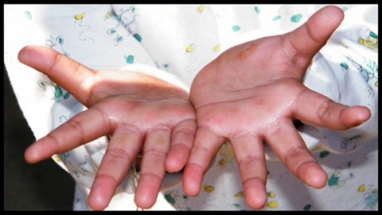 แนะศูนย์เด็กเล็ก-โรงเรียนอนุบาล คุมเข้มเปิดเทอม สกัดโรคมือ เท้า ปาก