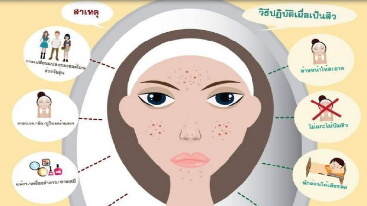 แพทย์ผิวหนังเตือน ภัยร้ายของการซื้อยารักษาสิวกินเอง