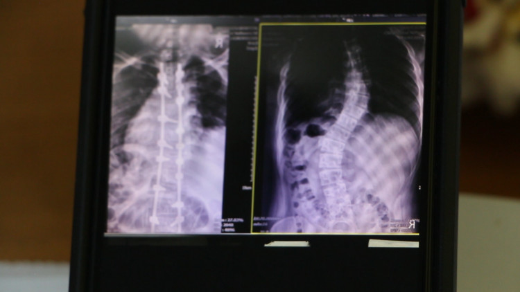 แพทย์ ชี้! 'น้องโทนี่' รักษากระดูกสันหลังคดงอได้โดยไม่ต้องผ่าตัด