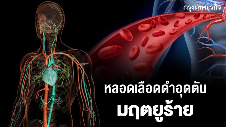 หลอดเลือดดำอุดตัน มฤตยูร้ายที่มองไม่เห็น