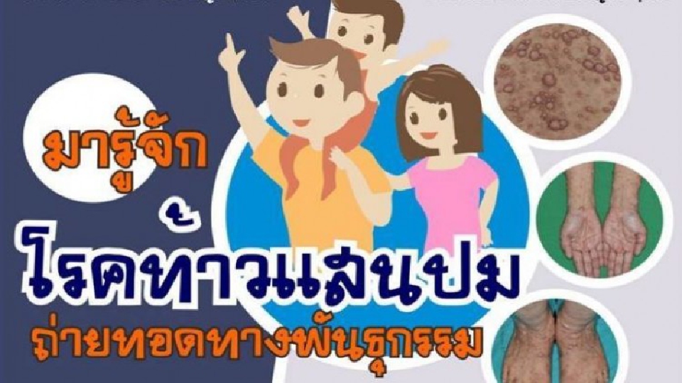 ชี้ 'โรคท้าวแสนปม' ไม่ใช่โรคติดต่อ วอนสังคมอย่ารังเกียจ