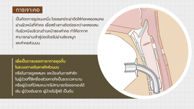 'เจาะคอ' อีกหนึ่งวิธีการช่วยเหลือผู้ป่วยที่ควรรู้