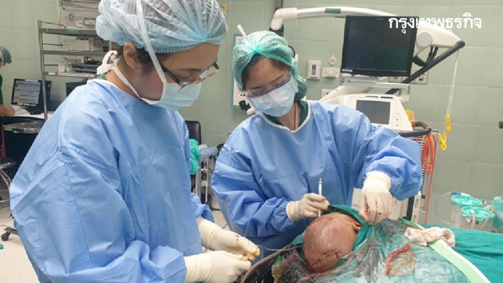 รพ.ราชวิถี ผ่าตัดกะโหลกเทียมเสมือนจริง ด้วยพิมพ์ 3D