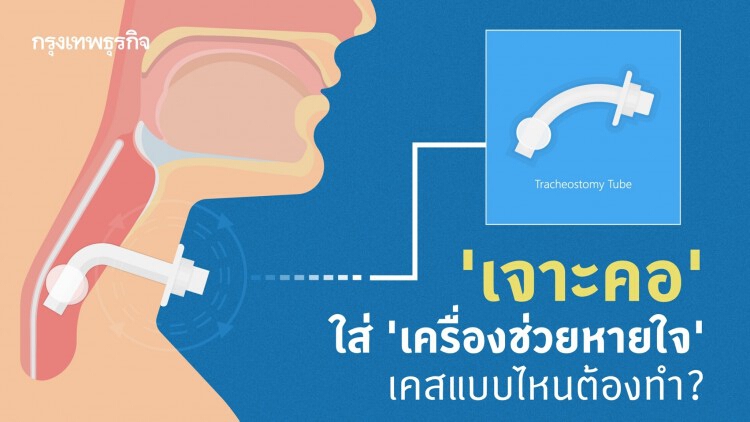 ต้องรู้! 'เจาะคอ' ใส่ 'เครื่องช่วยหายใจ' อาการแบบไหนต้องทำ?  