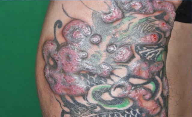 สมาคมแพทย์ผิวหนังฯเตือนภัยอันตรายจากการสัก