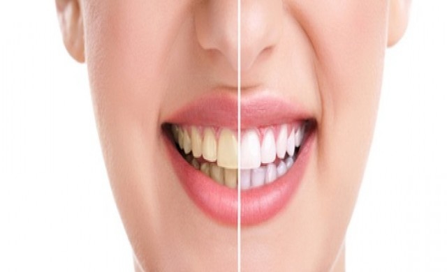 ทันตกรรมเคลือบผิวหน้าฟัน (Dental Veneers)