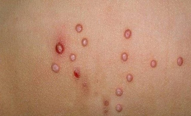 โรคติดเชื้อผิวหนังที่พบบ่อยในเด็ก VS ผู้ใหญ่ 