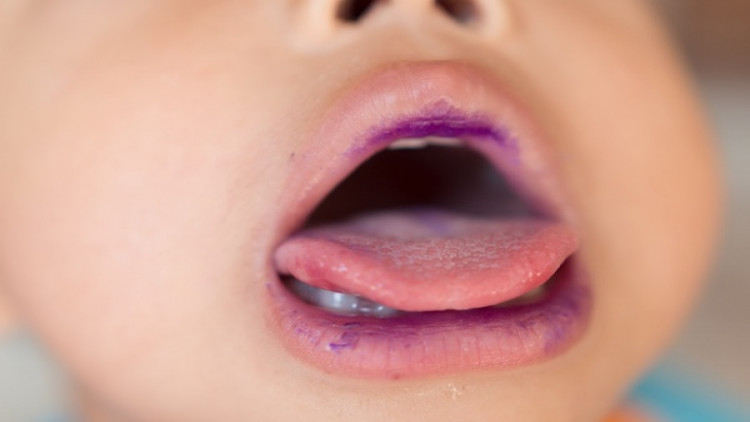 วินิจฉัยโรคมือเท้าปากด้วยวิธี PCRมีความรวดเร็วและแม่นยำ