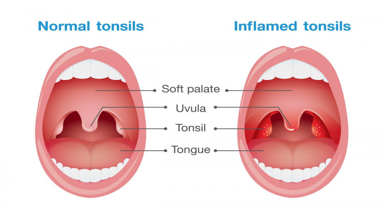 ทอนซิลอักเสบ ( Tonsillitis ) 