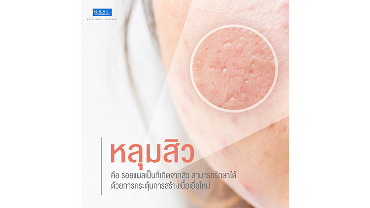 คุณรู้ไหม...สิ่งที่ยากกว่าการรักษาสิว คือ “แผลเป็นหลุมสิว” ที่เกิดจากสิวอักเสบ