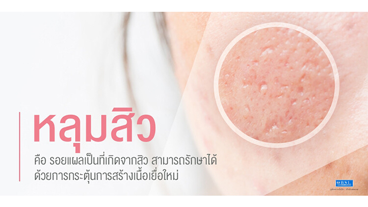 เปลี่ยนหน้าหลุมสิว ให้ผิวกลับมาเรียบเนียน