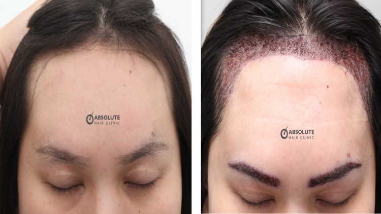 การปลูกผมในผู้ชายแปลงเพศเป็นหญิง