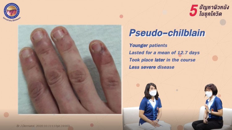 โรคโควิด-19 กับอาการทางผิวหนังที่ไม่ควรมองข้าม (ตอนที่ 1)