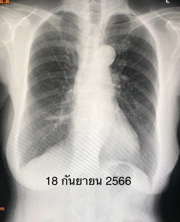 'หมอมนูญ' ยกเคสผู้ป่วยอายุ 74 ปี ปอดอักเสบ หลังติดเชื้อ RSV จากเด็กเล็กในบ้าน