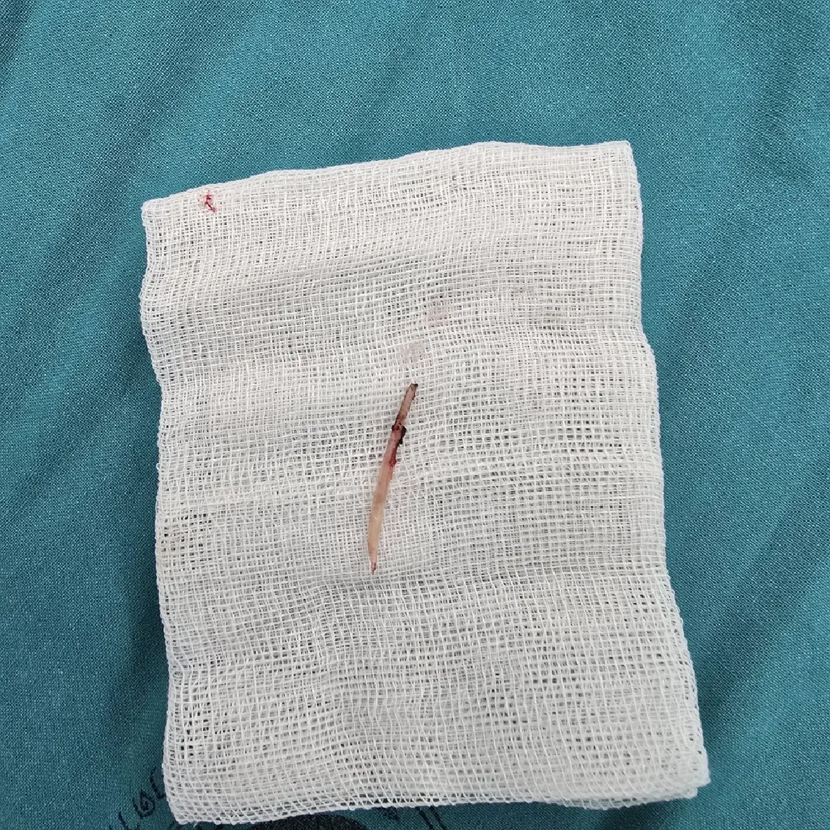 เข้าไปได้ไง หมอเตือน เคสคนไข้หนาวสั่น ปวดท้อง 1 วัน เจอก้างปลาทะลุ