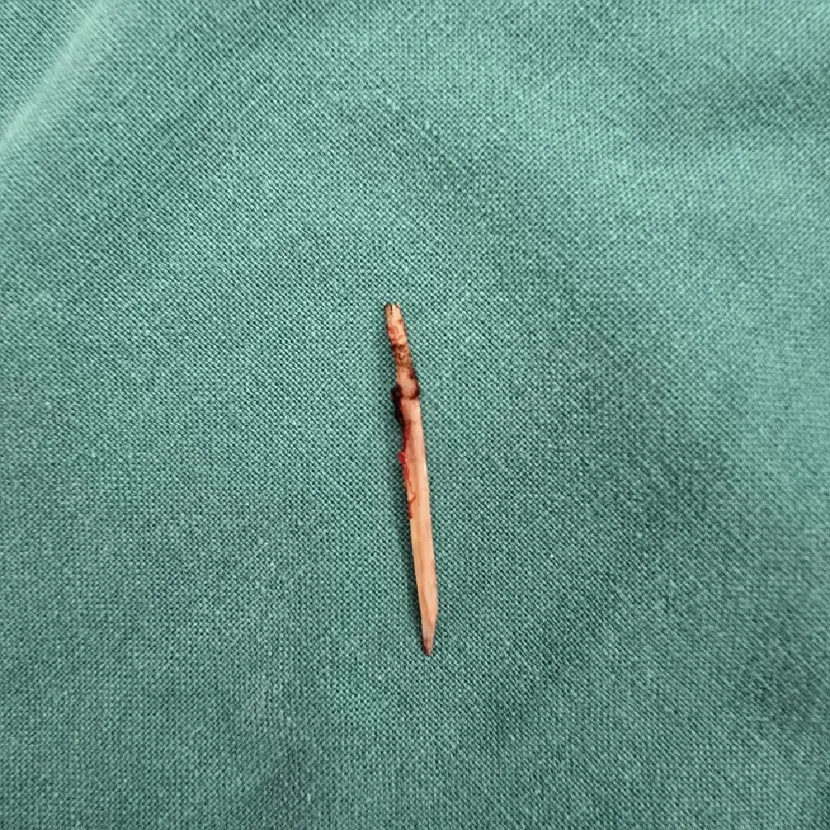 เข้าไปได้ไง หมอเตือน เคสคนไข้หนาวสั่น ปวดท้อง 1 วัน เจอก้างปลาทะลุ