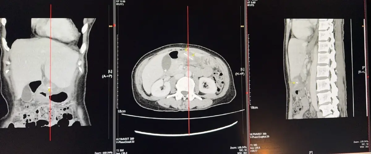 เข้าไปได้ไง หมอเตือน เคสคนไข้หนาวสั่น ปวดท้อง 1 วัน เจอก้างปลาทะลุ