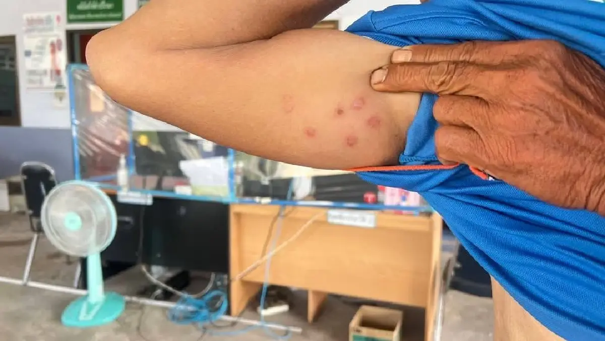 หนองบัวฯ พบผู้ต้องสงสัยติดเชื้อ แอนแทรกซ์ ชำแหละเนื้อ กินลาบดิบ