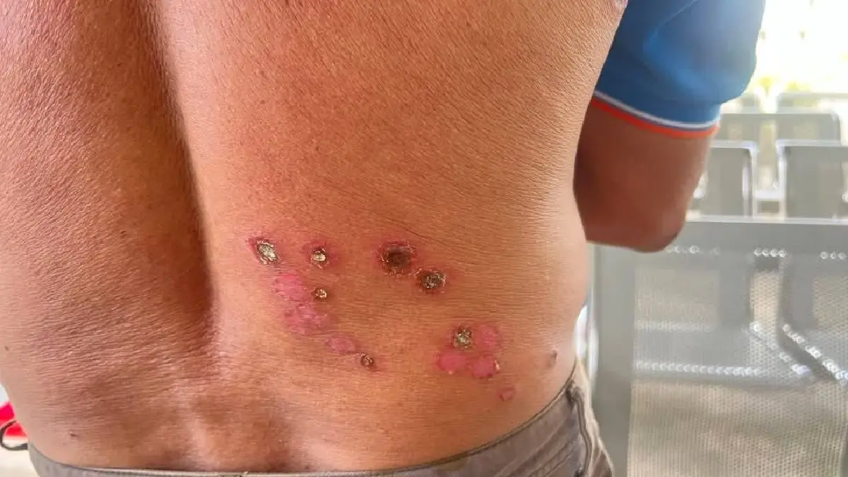 หนองบัวฯ พบผู้ต้องสงสัยติดเชื้อ แอนแทรกซ์ ชำแหละเนื้อ กินลาบดิบ