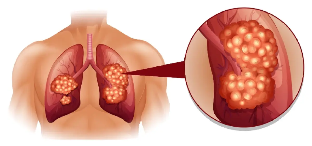 หยุดมะเร็งปอด! คร่า 41 ชีวิต/วัน  พบผู้ป่วยรายใหม่ 57 คน /วัน